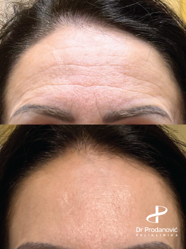 botox pre i posle